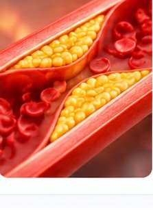High Cholesterol